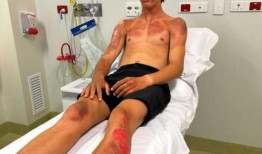 澳大利亚冲浪者詹森·柯比在印度尼西亚的一艘船爆炸中烧伤了13%的身体