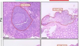 溃疡性结肠炎的一线药物发现有额外的作用机制，直到现在仍然难以捉摸