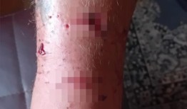 男子在社交媒体上为狗狗辩护几天后遭到XL Bully袭击｜英国新闻