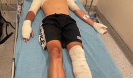 澳大利亚冲浪者詹森·柯比在印度尼西亚的一艘船爆炸中烧伤了13%的身体